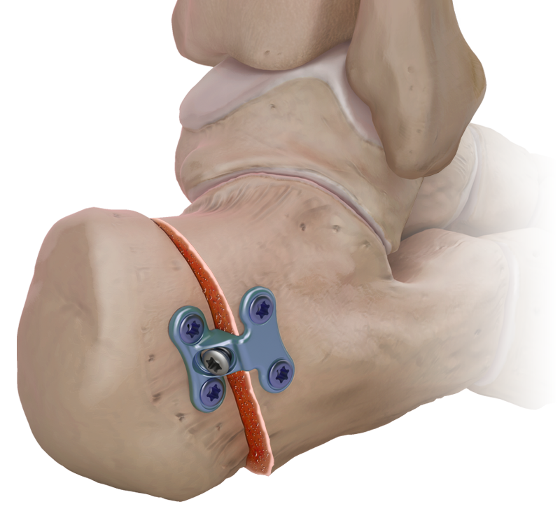 Arthrex - Calcaneus Step Plate, 10 mm - AR-8949-100
